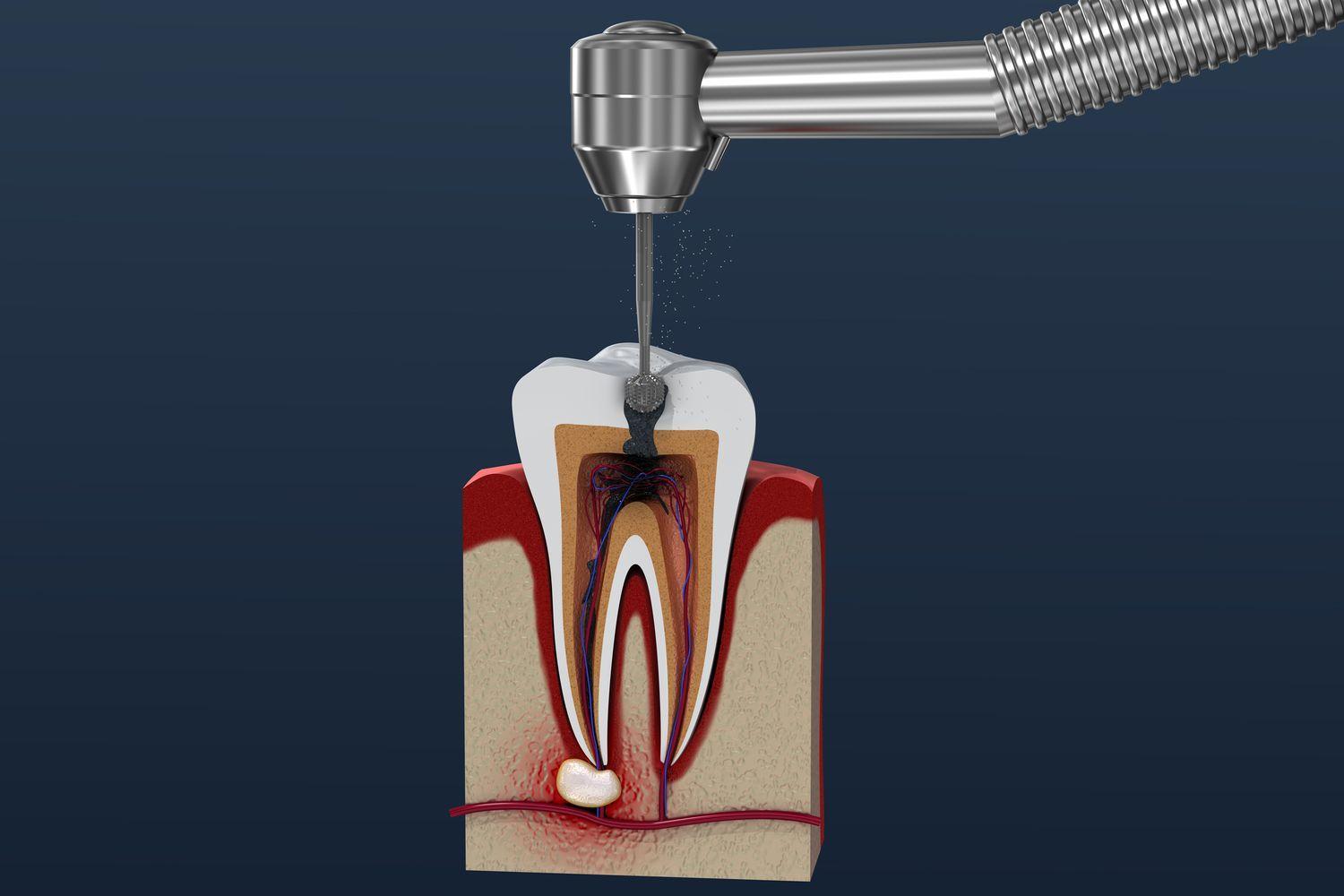 Leczenie endodontyczne